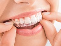 アライナー型矯正治療（マウスピース矯正）のイメージ